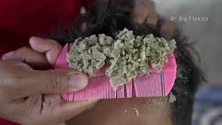 Dandruff Scratching Crazy Flakes!! | Dry Itchy Scalp Natural Dandruff Huge Flake #185