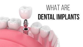 All you need to know about dental implant procedure