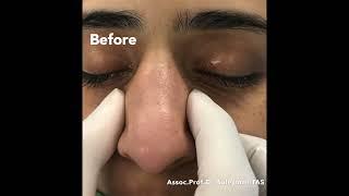 Wide Nose | Closed Atraumatic Rhinoplasty