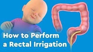 How to Perform a Rectal Irrigation for Patients with Hirschsprung Disease