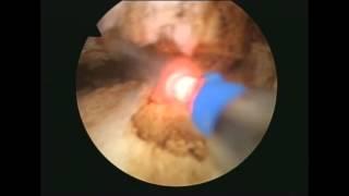 Laser prostate surgery - Complete thulium laser enucleation, Dr. Farid Gadimaliyev