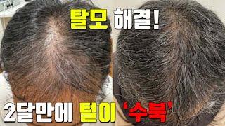 '모발 이식' 안하고 탈모 해결! - 호주 PRP 치료로 2달 만에 머리가 '수북'