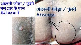 #Abscess मल द्वार के अंदर फोड़ा /फुंसी को कैसे पहचानें Lucknow piles specialist Dr Sanjeet 8858287131