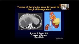 Tumors of the Inferior Vena Cava and their Surgical Management