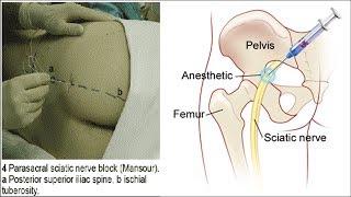 Блокада седалищного нерва | Как делается | Sciatic Nerve Block