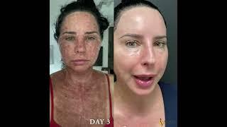 UltraClear Laser Weston Florida, Patient Discusses her recent treatment with 7 days of photos