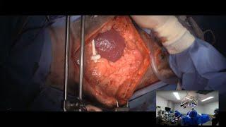 Live stream - exploratory surgery for intestinal foreign body in a dog