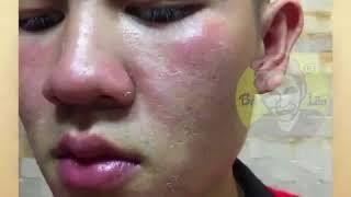 [ BÀ LÃO ] Thuốc trị mụn Bà Lão tốt nhất và an toàn hiệu quả nhất hiện nay