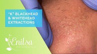 Blackhead & Whitehead Extractions on "K" - April 2022