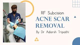  Treatments for ACNE SCARS ️ | Dr Adarsh Tripathi