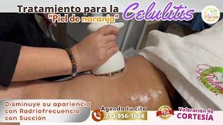 Tratamiento para la Reducir Celulitis en Paloma Clinic Spa#belleza #houston #share #spahouston