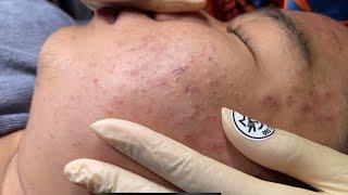 Blackheads & Whiteheads Removal New 2024 | Acne Treatment With Bo Nguyễn Spa #008