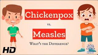 Chickenpox vs Measles: Which is Which?