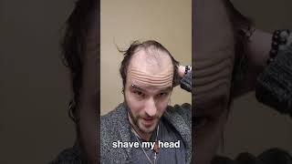 BALDING Man Has Life Changing TRANSFORMATION