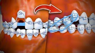 Así se componen los dientes chuecos