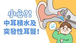 小心！中耳積水及突發性耳聾！【引起耳朵悶塞感的疾病(下)】