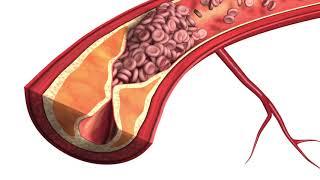 Atherosclerosis - Plaque Animation Model