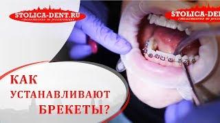  Процесс установки сапфировой и металлической брекет системы. Установка брекет системы. 12+