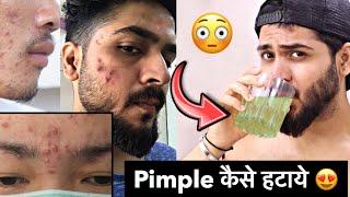 अपना Face ख़राब मत करो | Pimple, Acne | How to Remove Pimple | Pimple reasons #pimple #shorts