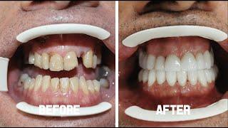 Zirconium Crowns (Smile Makeover) - James Jason From the U.K