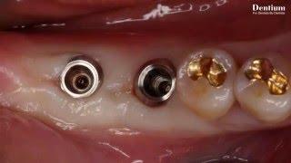 Dentium tissue level implant system - Simpleline ll (flapless surgery) -