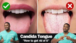 How To Fix A CANDIDA Yeast Overgrowth - Including Best Anti-fungal Herbs