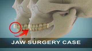 Corrective Jaw Surgery | Orthognathic Surgery | Curveia Dental Animation