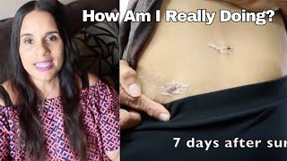 The Truth About Removing My Gallbladder 6 Years Later | What I Didn't Share In the 1st Video