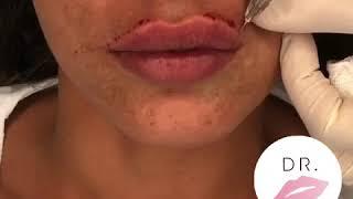 Filler Labbra by Dr. Pierluigi Gigliofiorito for Dr. Lips