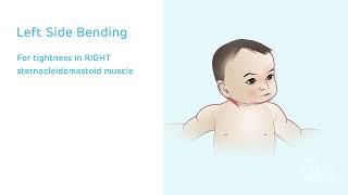 Congenital Muscular Torticollis: Stretching