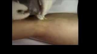 Scleroterapia dei capillari con schiuma. , by veneinforma