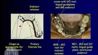 DENT 718: Removable partial dentures: design considerations