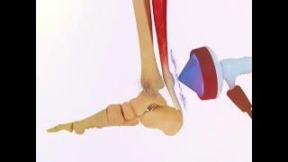 ESWT of Achiles Tendinitis