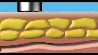 Les soins corporels Méthode Laurand - Part 1 : Les ultrasons