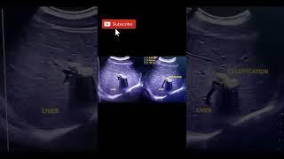 Liver hepatic calcification#ultrasound#shorts