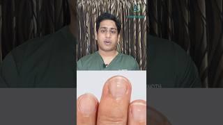 விரல் நகத்தில் ஏற்படும் வெள்ளை புள்ளிகள்| White spots on finger nail causes| வெள்ளை புள்ளிகள் காரணம்