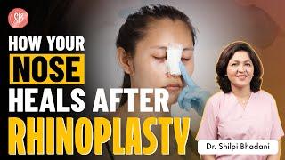 Rhinoplasty: Recovery, Surgery Cost, Aftercare | Nose Job Surgery Aftercare | SB Aesthetics