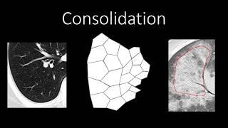 Chest Radiology - Patterns - Airspace