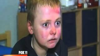 Nicholas Zahorcak w/Recessive Dystrophic Epidermolysis Bullosa