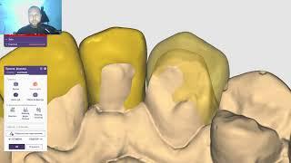 Разбор работы планирование как сделать виниры, если кривые зубы? Разбор работы exocad
