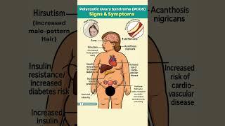 PCOS Signs & Symptoms - What Every Woman Should Know