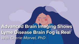 Advanced Brain Imaging Shows Lyme Disease Brain Fog is Real | Johns Hopkins Rheumatology