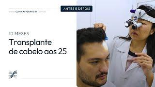 Transplante capilar jovem | Antes e depois | Caique