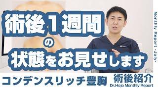 【症例紹介】コンデンスリッチ豊胸の一週間後の術後紹介／北條 誠至 医師