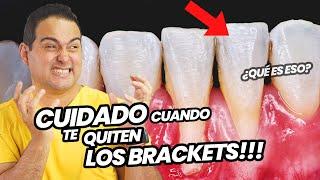 LO QUE NADIE TE DICE SOBRE EL RETIRO DE TUS BRACKETS - CUIDADO CUANDO TE QUITEN LA ORTODONCIA. 