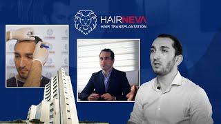 Hakan Enes Ermiş True Hair Transplantation Story From Beginning to End