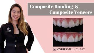 What is Composite Bonding and Composite Veneers? What you need to know before you have treatment!