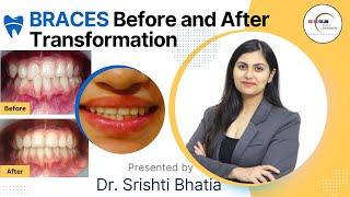 BRACES Before and After Transformation: Dr. Srishti Bhatia #braces #smilemakeover