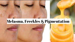 Melasma, Freckles Pigmentation Home Remedy| Get Younger Glowing Spotless Skin In Just 7 Days