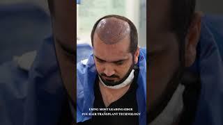 FUE Hair Transplant with DHI Technology by Hair Club